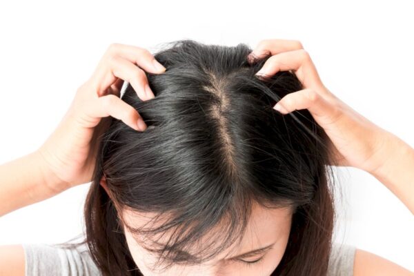 5 Tips to Get Rid of Your Itchy Scalp